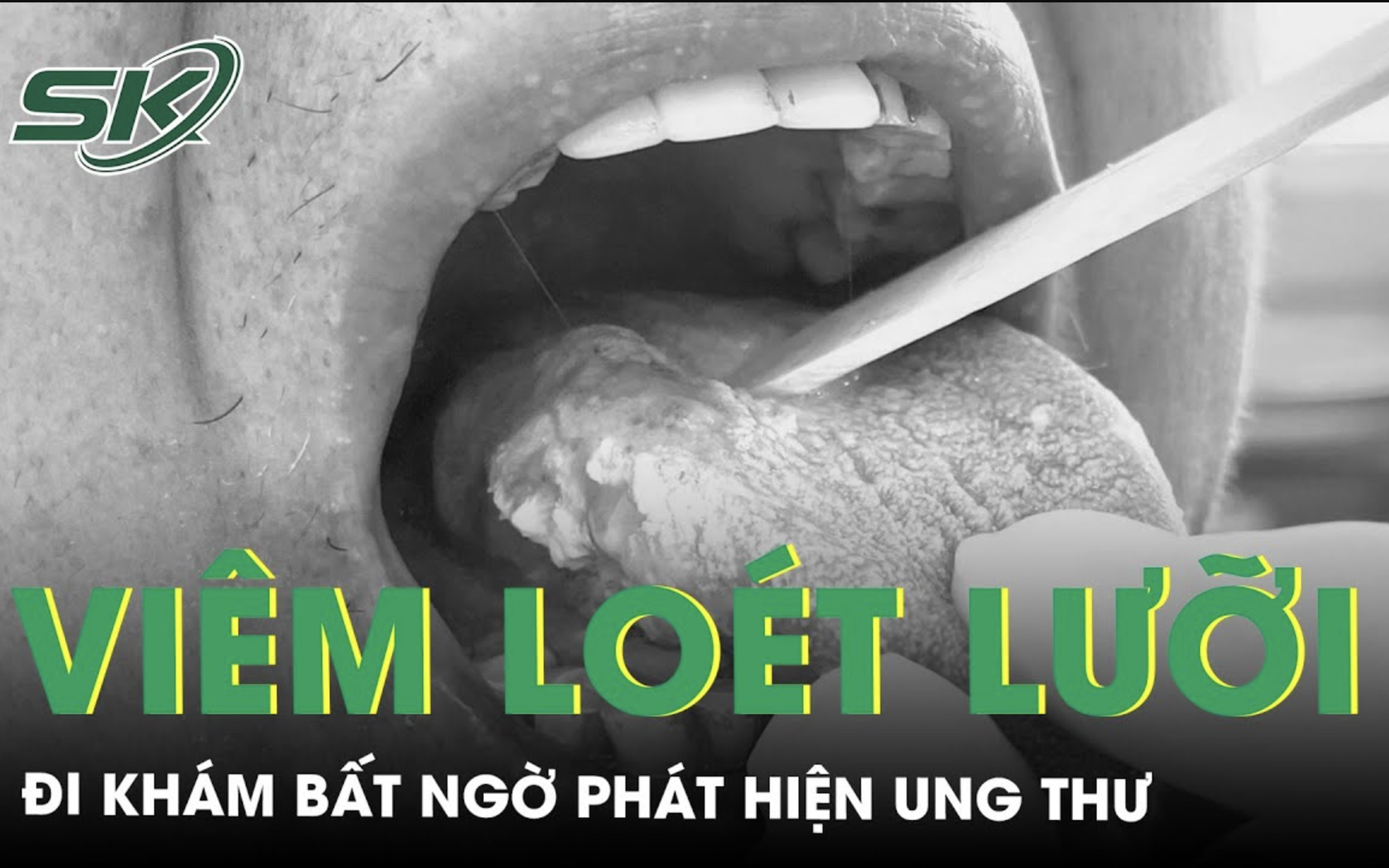Viêm loét, đau rát lưỡi hơn một tháng đi khám phát hiện ung thư lưỡi