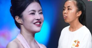 300 giờ phẫu thuật, 120 ngày thay đổi diện mạo: Vì sao chỉnh hàm chưa phải ‘điểm kết’?