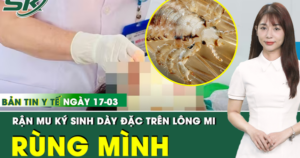 Bản tin Y tế 17/3: Rùng mình rận mu ký sinh dày đặc trên lông mi người phụ nữ