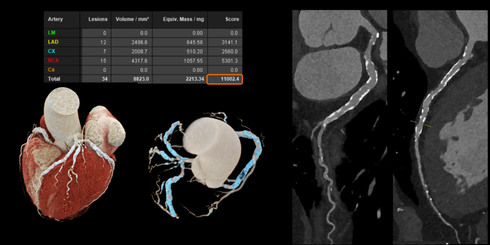 Công nghệ cắt lớp vi tính lượng tử: Mở ra cơ hội phát hiện sớm và điều trị chính xác hơn cho người bệnh- Ảnh 2.