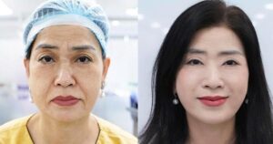 Căng da mặt – khi trẻ hóa không còn là ‘kéo da’ đơn thuần