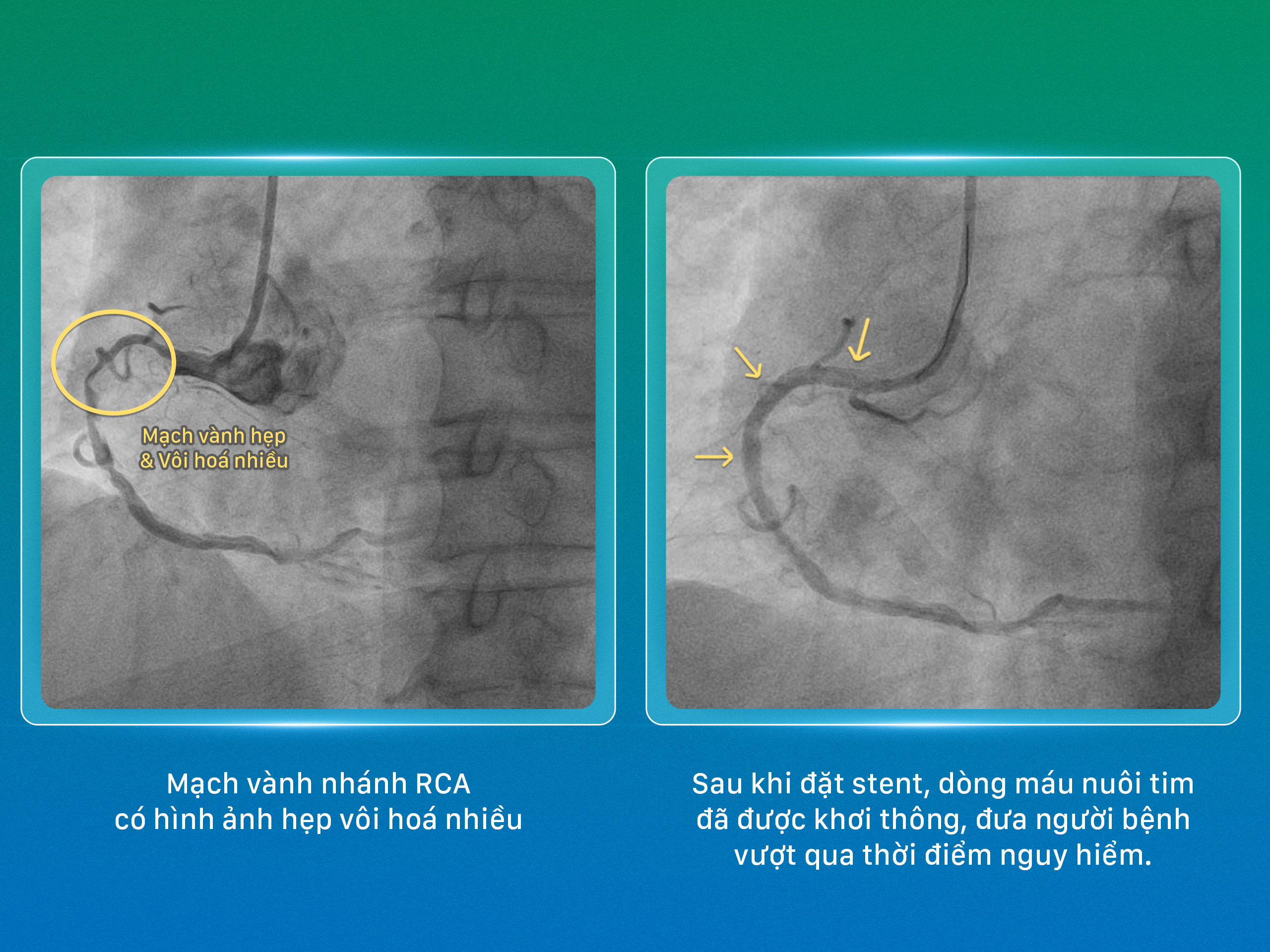 Bệnh viện Phương Đông: Nghẹt thở khơi thông 3 nhánh mạch vành hẹp khít, giành lại dòng máu nuôi tim cho bệnh nhân 72 tuổi- Ảnh 2.