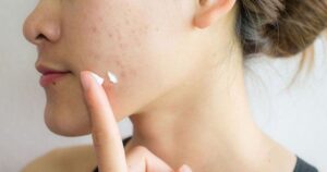 6 sai lầm khi chữa mụn trứng cá