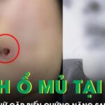 Rạch ổ mủ tại nhà, người phụ nữ gặp biến chứng nặng sau tiêm filler