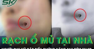 Rạch ổ mủ tại nhà, người phụ nữ gặp biến chứng nặng sau tiêm filler