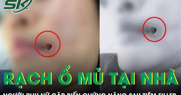 Rạch ổ mủ tại nhà, người phụ nữ gặp biến chứng nặng sau tiêm filler