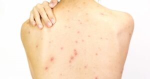 Nguyên nhân mọc mụn trứng cá ở lưng, yếu tố thường gặp nhưng dễ bị bỏ qua