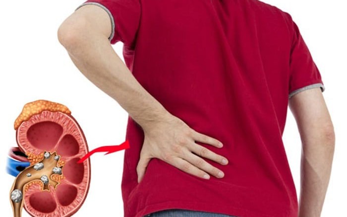 Sỏi thận có gây rối loạn cương dương?