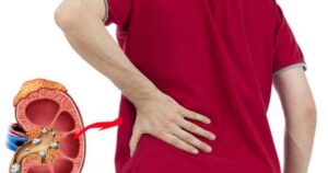 Sỏi thận có gây rối loạn cương dương?