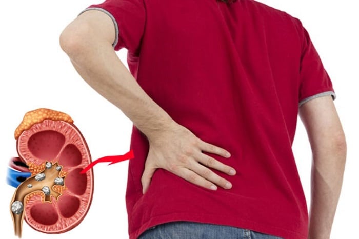 Sỏi thận có gây rối loạn cương dương?- Ảnh 1.