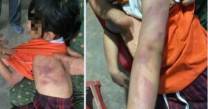 Bé gái lớp 2 bị bạn đánh bầm tím người