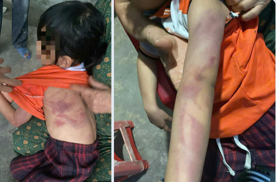 Bé gái lớp 2 bị bạn đánh bầm tím người- Ảnh 1.