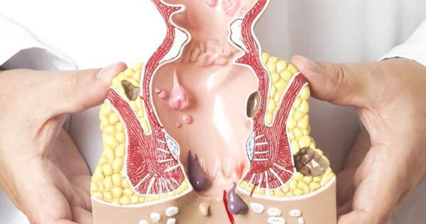 Bệnh trĩ ngoại có gây biến chứng không?