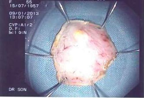 Người phụ nữ phát hiện mang khối u dạ dạy kích thước khổng lồ từ triệu chứng bất thường- Ảnh 3.