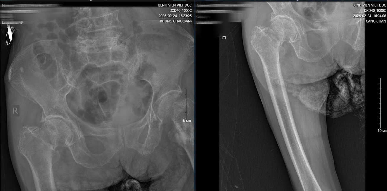 16 ngày, 2 cuộc đại phẫu cứu cụ bà 89 tuổi ở Bệnh viện Việt Đức- Ảnh 2.