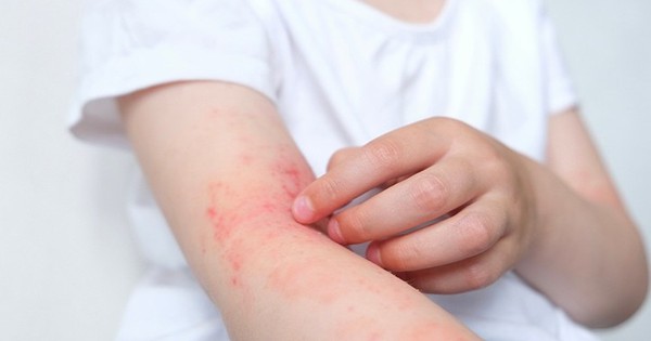 Cách chọn kem dưỡng ẩm trong liệu trình điều trị viêm da dị ứng tốt nhất