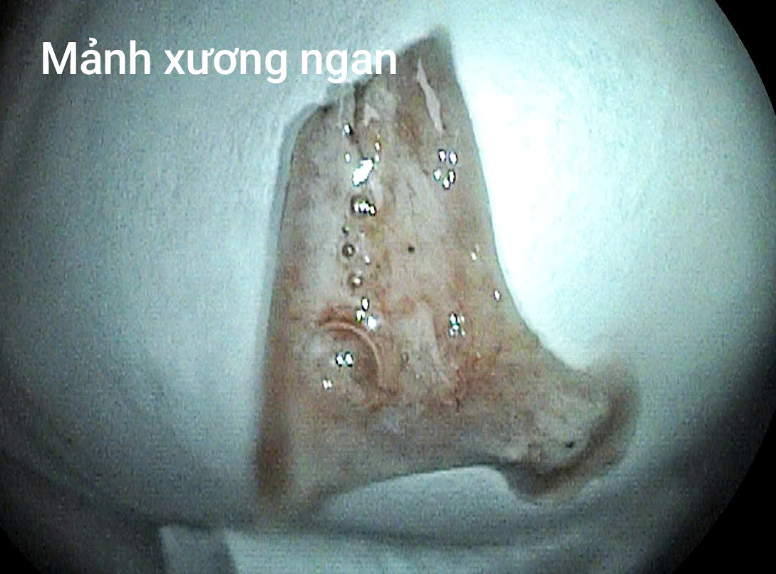 Người đàn ông cấp cứu sau bữa ngan luộc- Ảnh 2.