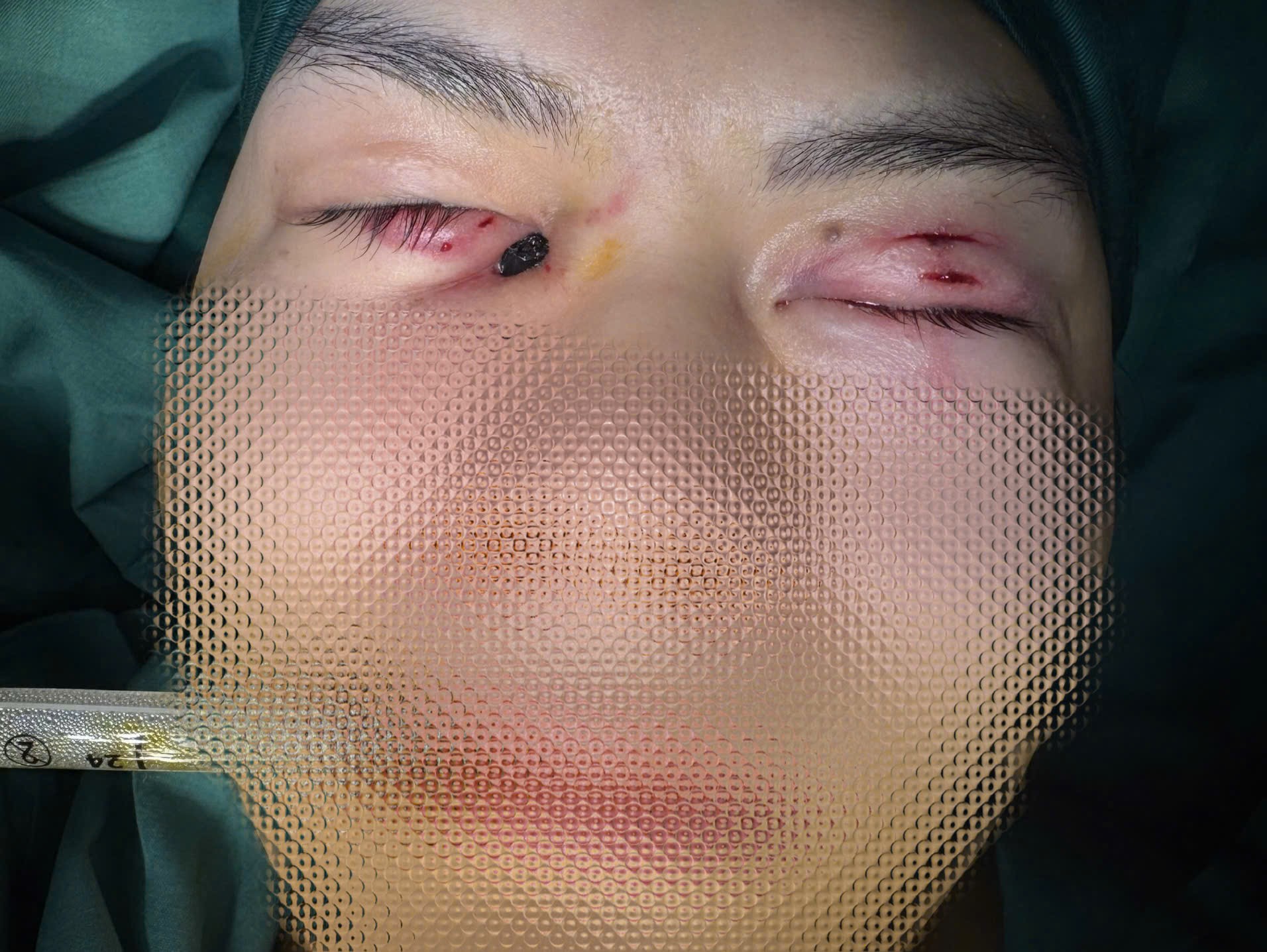 Chưa từng có trong y văn: Người bệnh đến viện cấp cứu với 2 chiếc đũa đâm sâu vào 2 mắt- Ảnh 1.