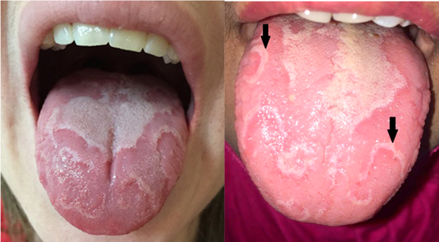 6 lưu ý về viêm lưỡi bản đồ ở trẻ em- Ảnh 1.