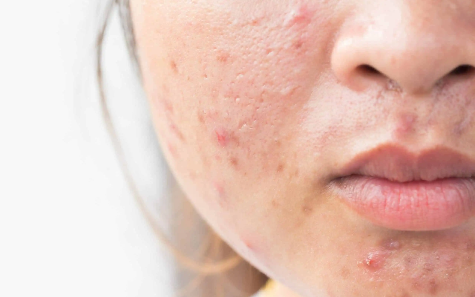 Thực phẩm dễ gây mụn trứng cá