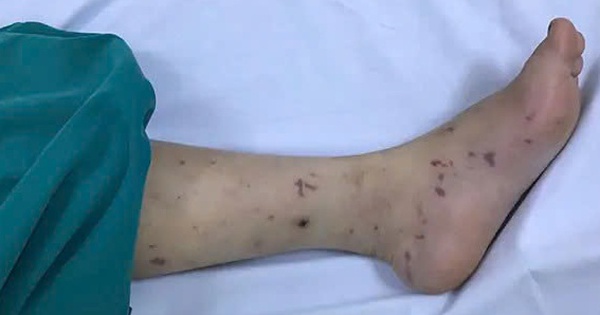 Bé 2 tuổi tử vong do não mô cầu thể tối cấp tại TPHCM