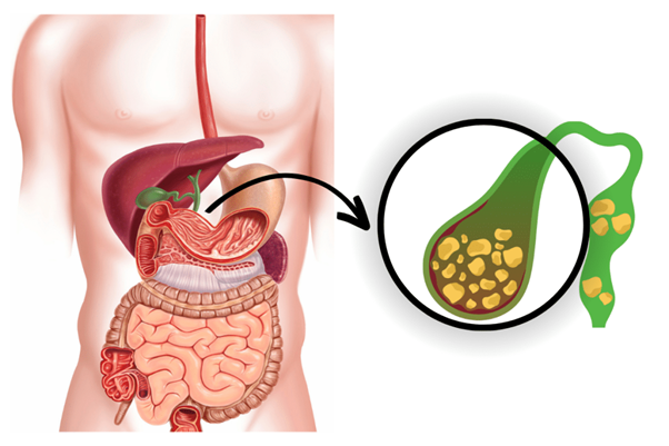 Vì sao sỏi mật hay tái phát và cách phòng ngừa hiệu quả- Ảnh 1.