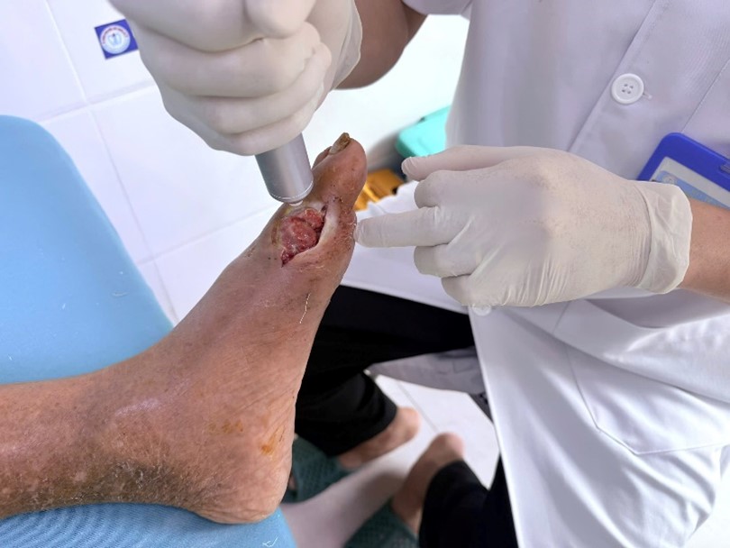 Ứng dụng kỹ thuật cao, Bệnh viện Nội tiết Nghệ An nâng hiệu quả điều trị loét bàn chân- Ảnh 3.
