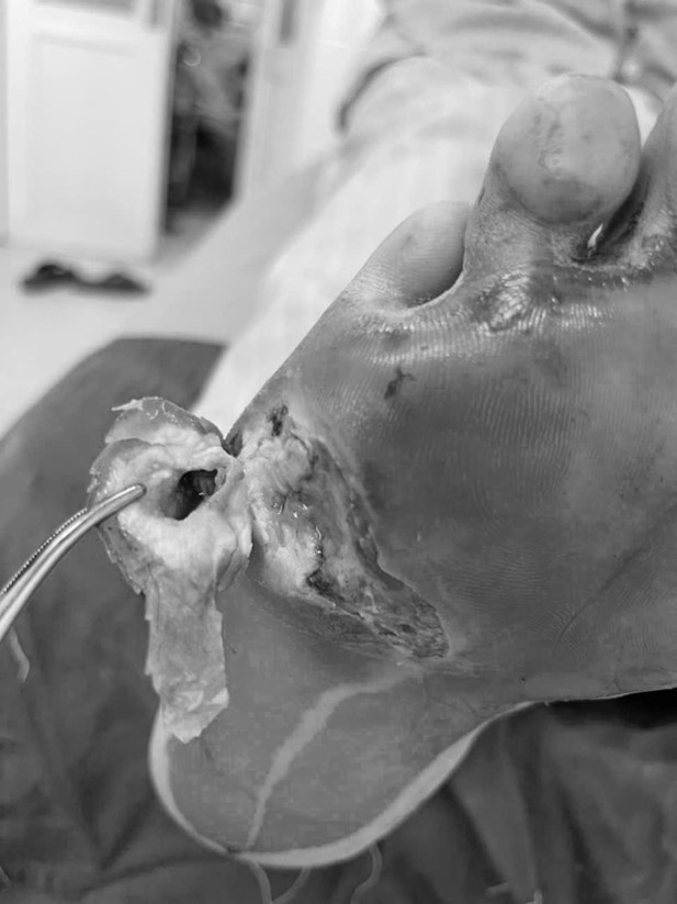 Ứng dụng kỹ thuật cao, Bệnh viện Nội tiết Nghệ An nâng hiệu quả điều trị loét bàn chân- Ảnh 5.