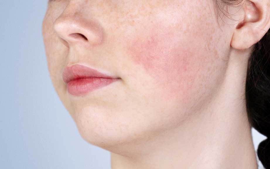 7 tác dụng phụ thường gặp khi sử dụng retinol và cách phòng ngừa