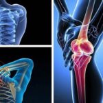 Không vận động mạnh tại sao vẫn bị thoái hoá?