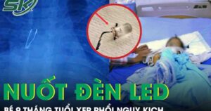Kinh hoàng: Bé 9 tháng tuổi xẹp phổi vì nuốt bóng đèn LED