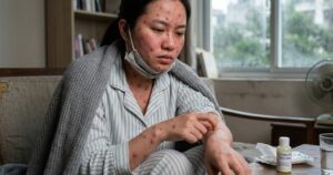 Cách điều trị bệnh thủy đậu tại nhà, ngăn ngừa sẹo