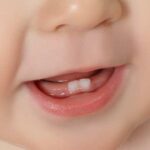 Trẻ chậm mọc răng: nguyên nhân và dấu hiệu cần lưu ý
