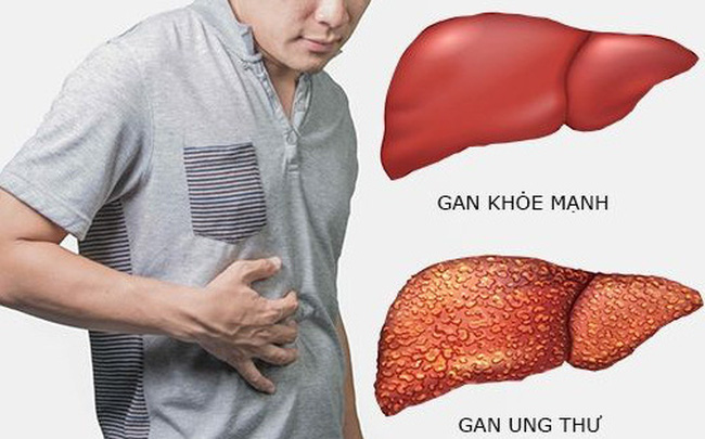 Yếu tố nguy cơ làm tăng tỷ lệ mắc ung thư gan- Ảnh 1.
