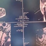 Sinh thiết đích qua tầng sinh môn, bệnh nhân ung thư tiền liệt tuyến được can thiệp kịp thời, điều trị ổn định