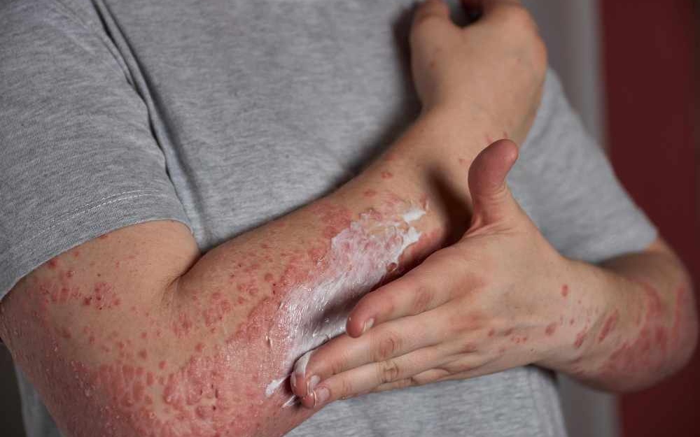 Ai có nguy cơ mắc viêm da dị ứng?