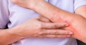 Viêm da dị ứng mùa Xuân: Lưu ý khi tự điều trị, tránh lạm dụng thuốc bôi