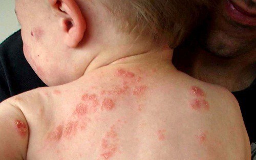 Trẻ bị viêm da dị ứng khi nào cần gặp bác sĩ?