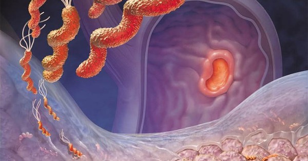 Viêm loét dạ dày – tá tràng: Dùng thuốc đúng cách để bảo vệ niêm mạc