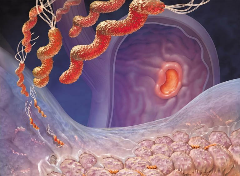Viêm loét dạ dày – tá tràng: Dùng thuốc đúng cách để bảo vệ niêm mạc- Ảnh 1.