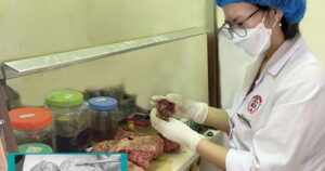 Người phụ nữ 46 tuổi mang trong mình khối u tử cung khổng lồ nặng 5kg