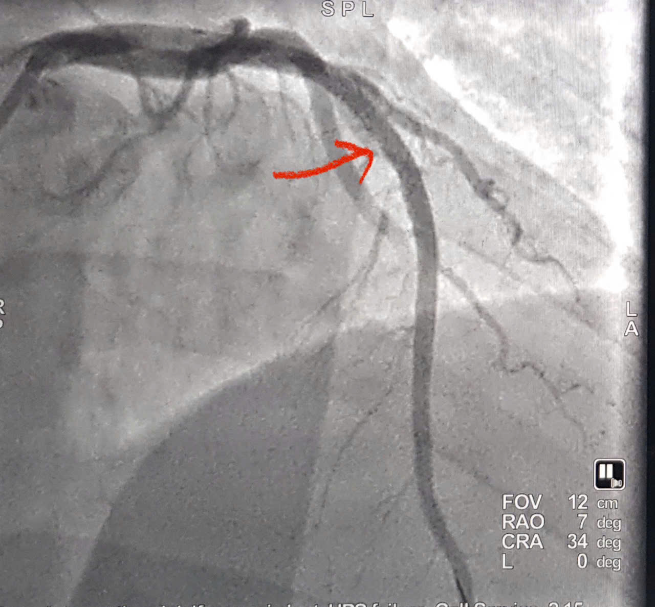 Cứu sống bệnh nhân người nước ngoài nhồi máu cơ tim cấp
- Ảnh 2.