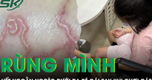 Tá hỏa phát hiện bắp chân bé gái 9 tuổi đầy vết ngoằn ngoèo bất thường