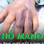 Đi làm ruộng bị rắn hổ mang cắn, người đàn ông suýt mất cánh tay