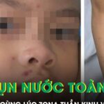 Bé trai 4 tuổi nổi kín mụn nước toàn thân sau khi mắc cùng lúc zona thần kinh và thủy đậu
