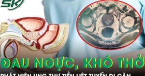 Phát hiện ung thư tiền liệt tuyến di căn từ triệu chứng đau ngực khó thở