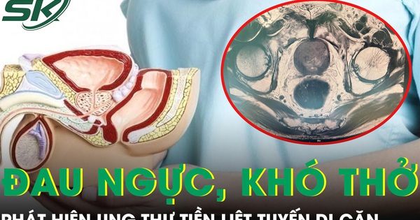 Phát hiện ung thư tiền liệt tuyến di căn từ triệu chứng đau ngực khó thở