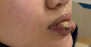 Biến dạng môi sau tiêm ‘giải filler’ tại spa