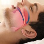 Hội chứng ngưng thở khi ngủ: Biện pháp nào để điều trị hiệu quả?