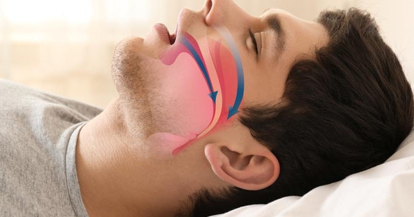 Hội chứng ngưng thở khi ngủ: Biện pháp nào để điều trị hiệu quả?